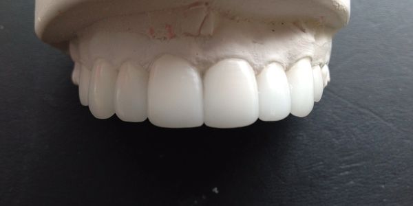 Diagnostic wax up case planning
