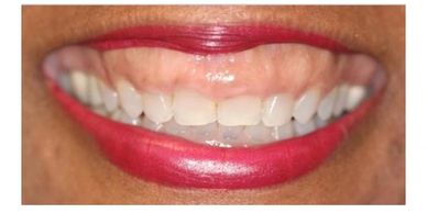 "Gummy smiles" are so called because of the excessive gum tissue displayed on smiling.
