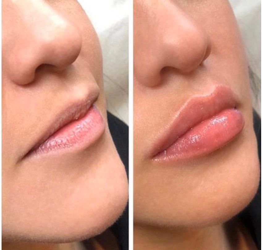 needleless lip filler needleless lip filler