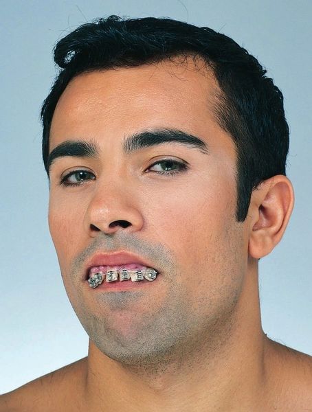 Ugly Teeth with Braces - Nerdy - Halloween Sale