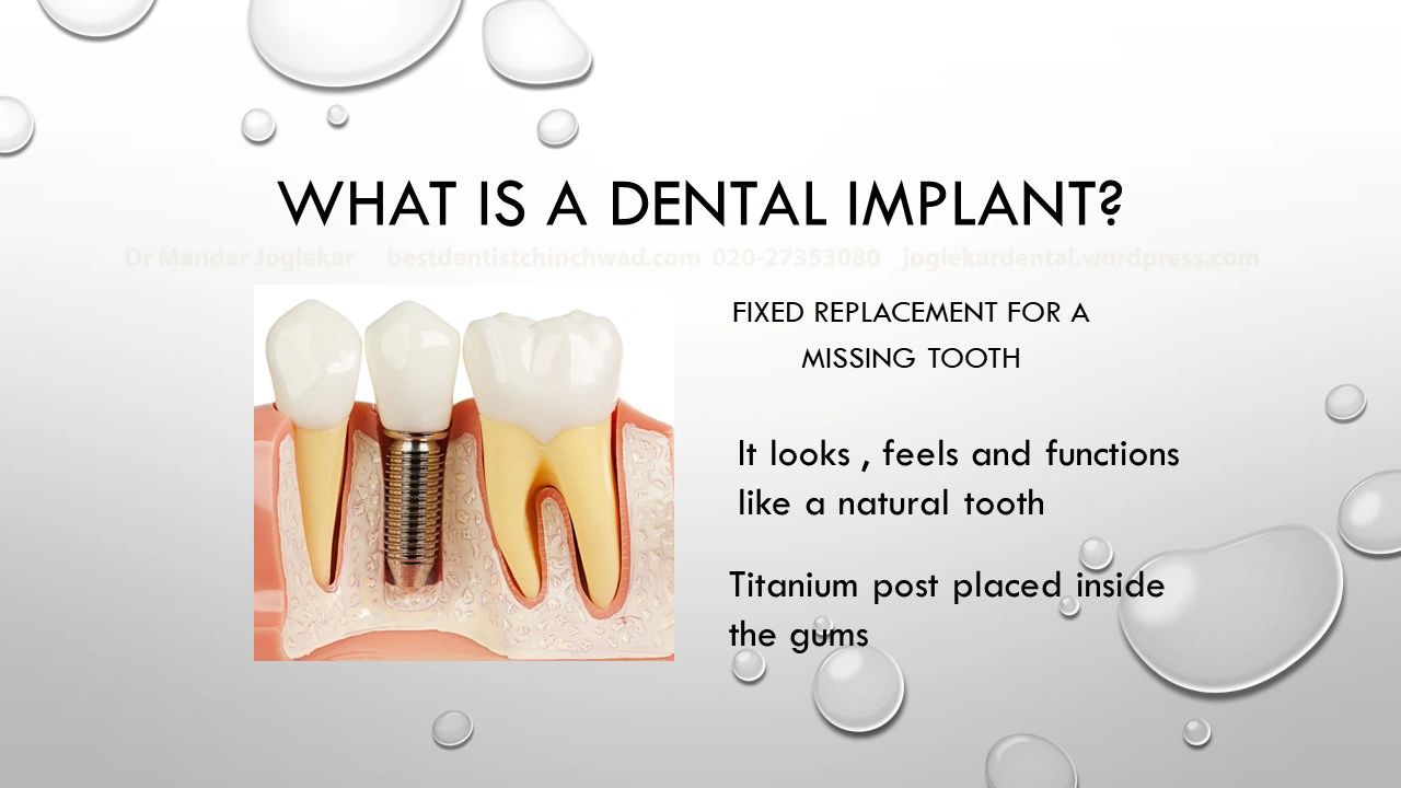 Dental Implants at  Joglekar’s dental solutions, Chinchwad