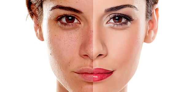 une femme avec une moitié de visage avec des taches pigmentaires et des imperfections 