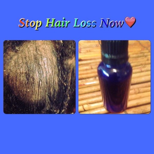 H2BN Ancient Stop Hair Loss Solution Now On Sale