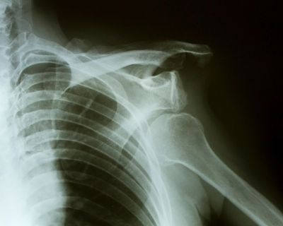 Left Shoulder dislocation XR, Dr David Drynan orthopaedic surgeon, Shoulder and elbow surgeon.