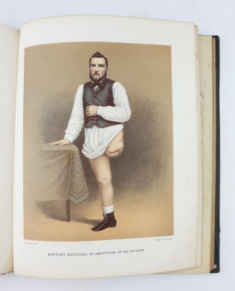 Civil War Medical Book – Hip Joint Amputations / SOLD