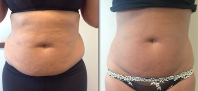 pictures of belly of a person before and after treatment 