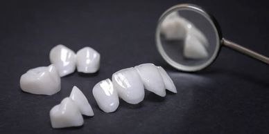 Cosmetic Dentistry. Crowns, bridges and veneers. All ceramic. 