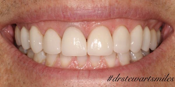 Porcelain veneers smile makeover